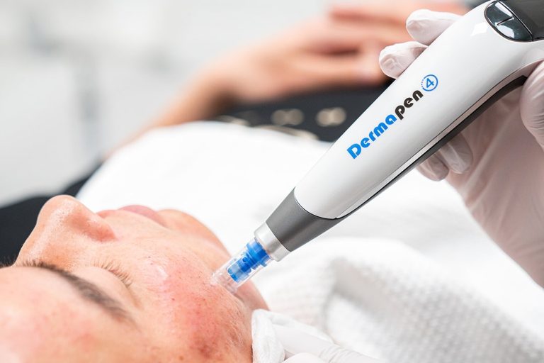 dermapen-machine-goes-over-acne-scars-to-decrease-their-appearance